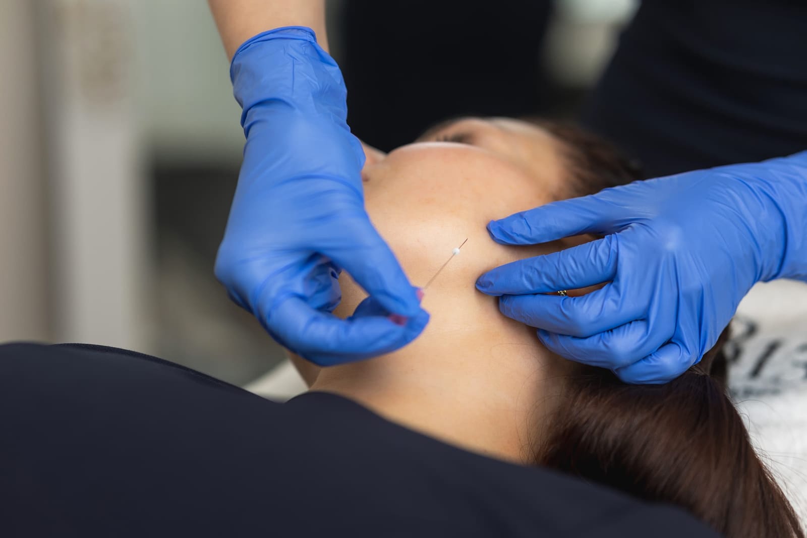 Aknearvet – SH Esthetics Oulu