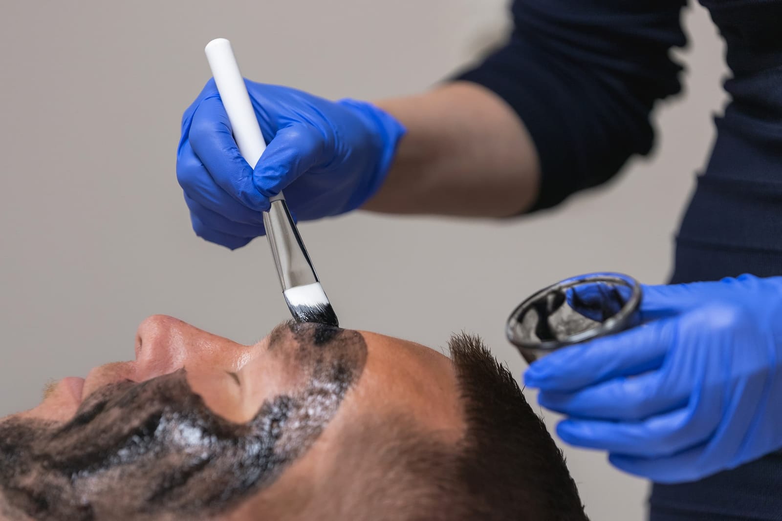 Kemiallinen kuorinta – SH Esthetics Oulu