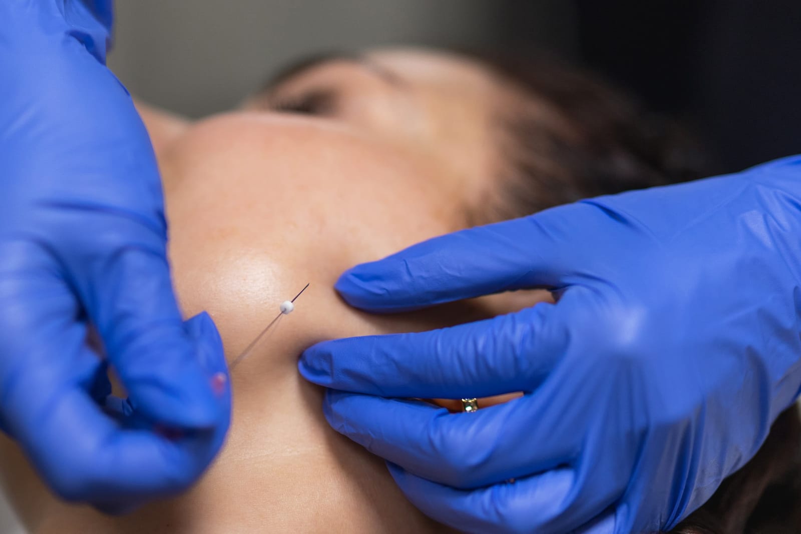 Polynukleotidit – SH Esthetics Oulu